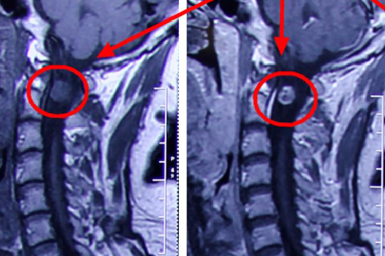 良性神经鞘瘤影像检查图
