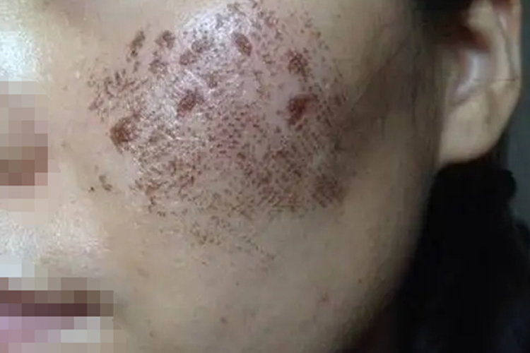 激光祛痘印第4-5天恢复图 激光祛痘印第4-5天恢复图