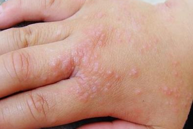 手背手癣图