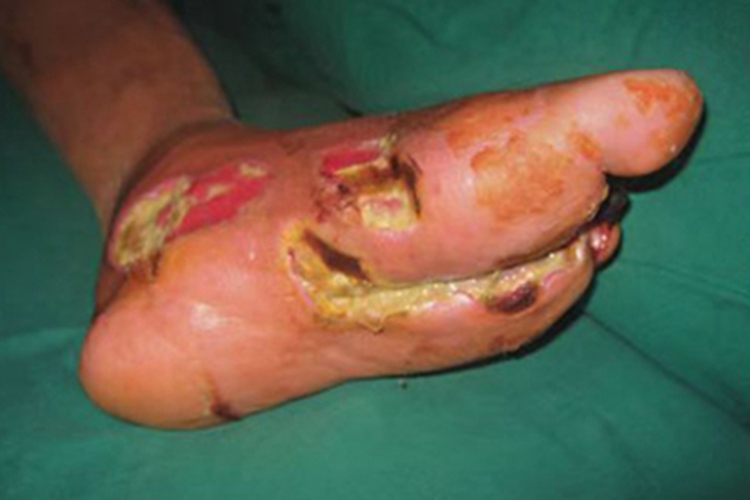 坏死性筋膜炎脚部缺损图 坏死性筋膜炎脚部缺损图