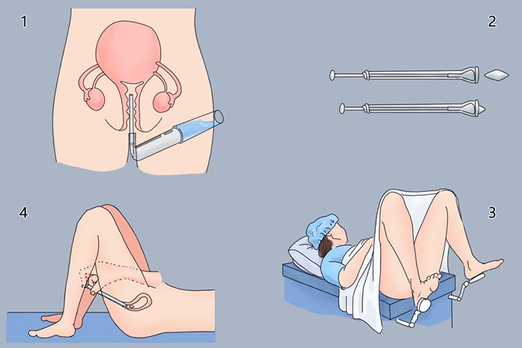 双唑泰阴膨胀栓的使用方法图