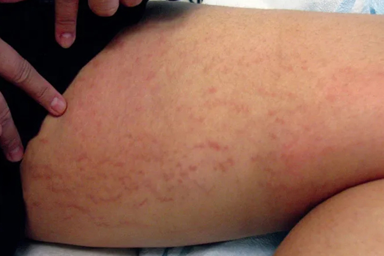 青少年腿部膨胀纹图 青少年腿部膨胀纹图