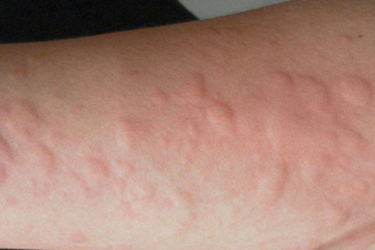 皮肤过敏红肿胳膊疙瘩图 皮肤过敏红肿胳膊疙瘩图