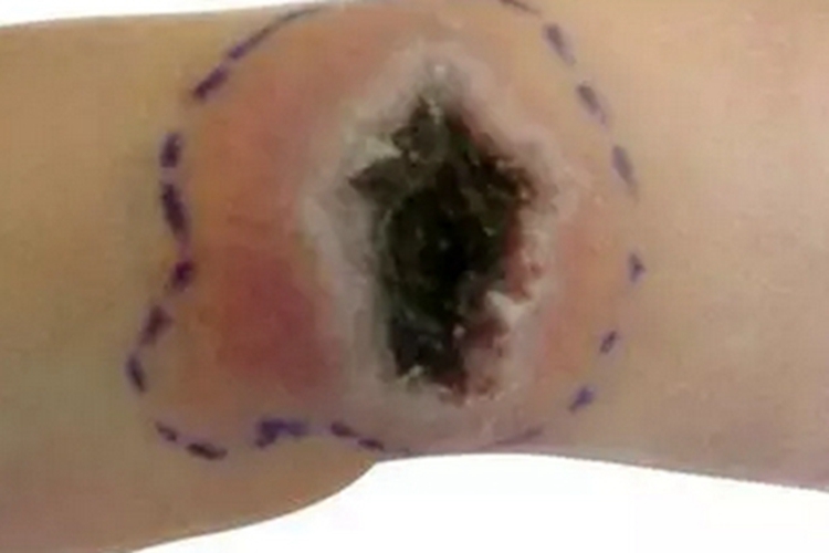 牛痘胳膊黑痂溃疡图 牛痘胳膊黑痂溃疡图