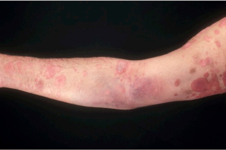 点滴型副银屑病胳膊红斑图