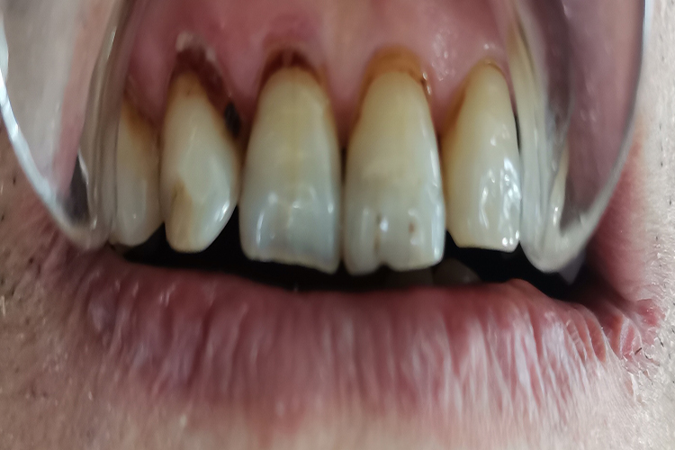 牙龈萎缩龋齿图