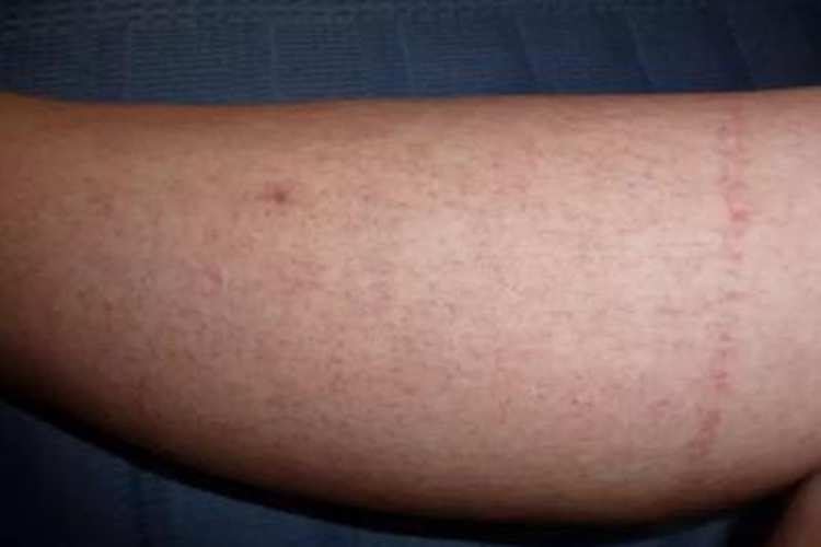 登革热小腿血点图