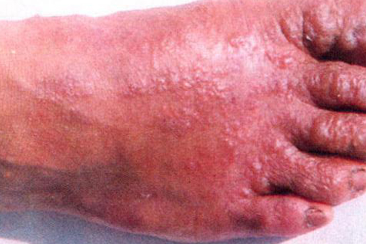 接触性皮炎图