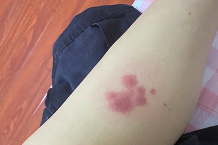 单纯疱疹小腿症状图