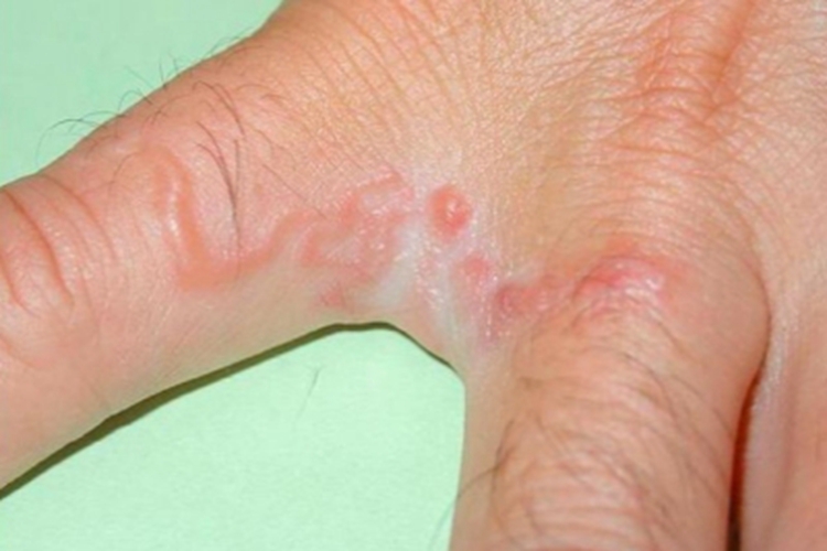 颚口线虫病手指缝症状图 颚口线虫病手指缝症状图