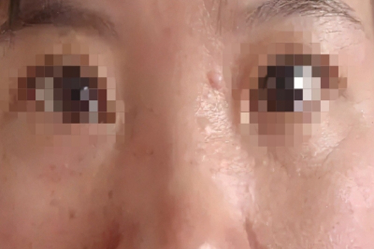 孤立性毛发上皮瘤症状图 孤立性毛发上皮瘤症状图