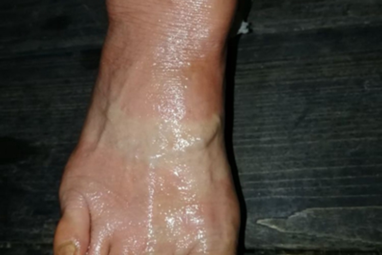 一度烫伤脚背皮肤发红图