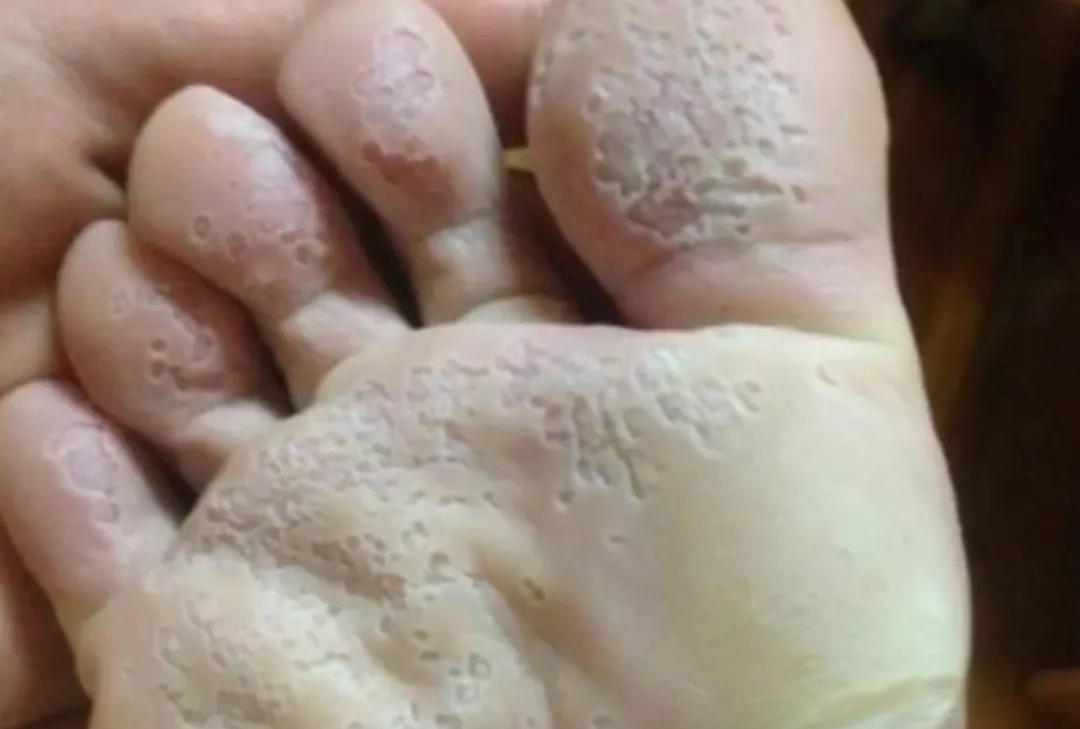 窝状角质松解症图