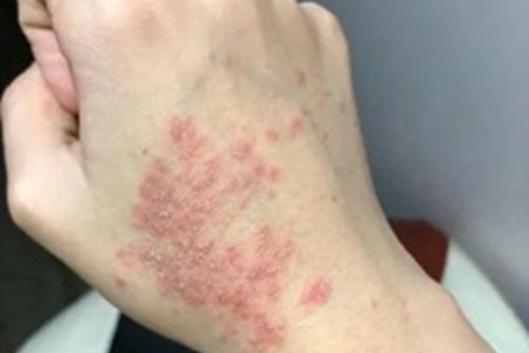 妊娠疱疹手背红斑图