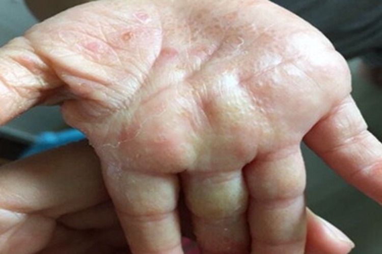 汗疱疹手掌上长了好多水疱图 汗疱疹手掌上长了好多水疱图