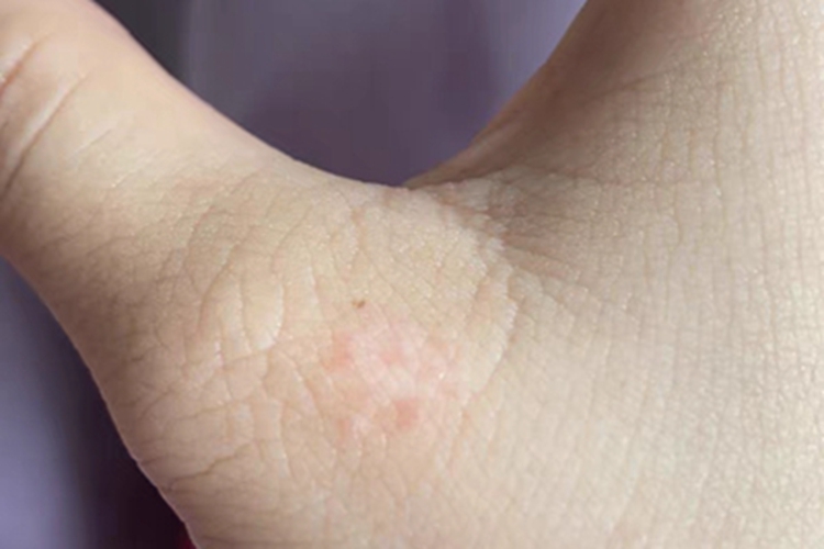 白癜风长红点图 白癜风长红点图