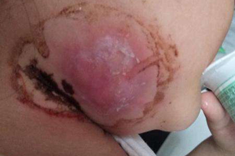 面颈部放线菌病面部脱皮图