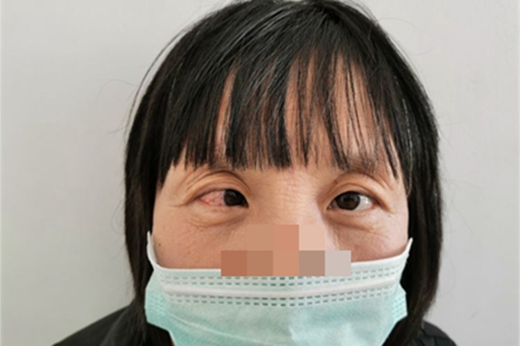 麻痹性斜视右眼内斜视图 麻痹性斜视右眼内斜视图