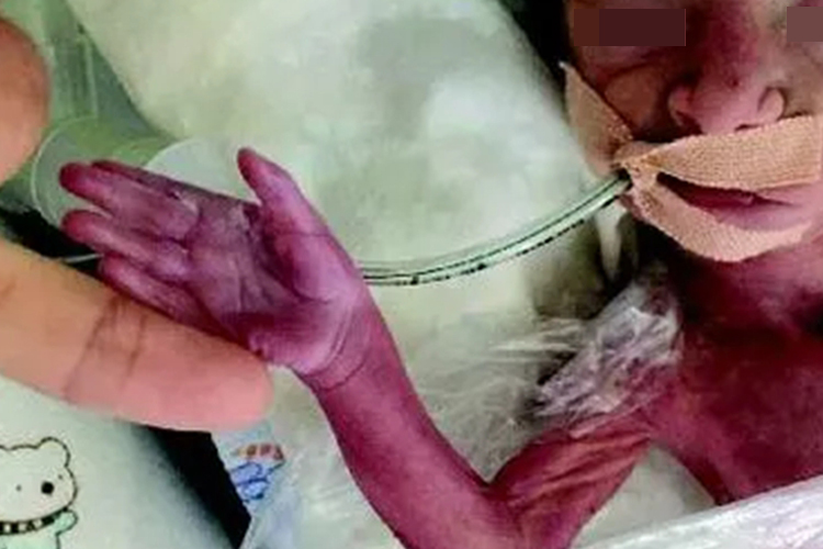 新生儿病理性紫绀图