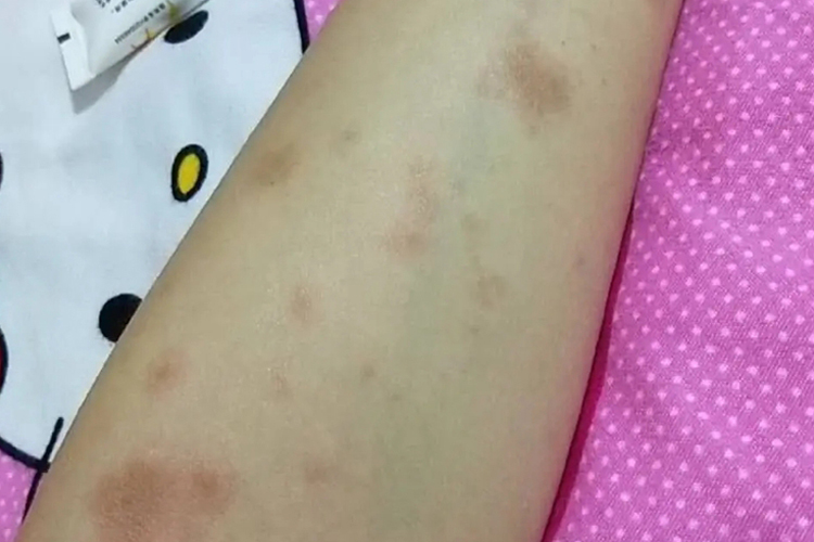 艾滋病初期血块图片