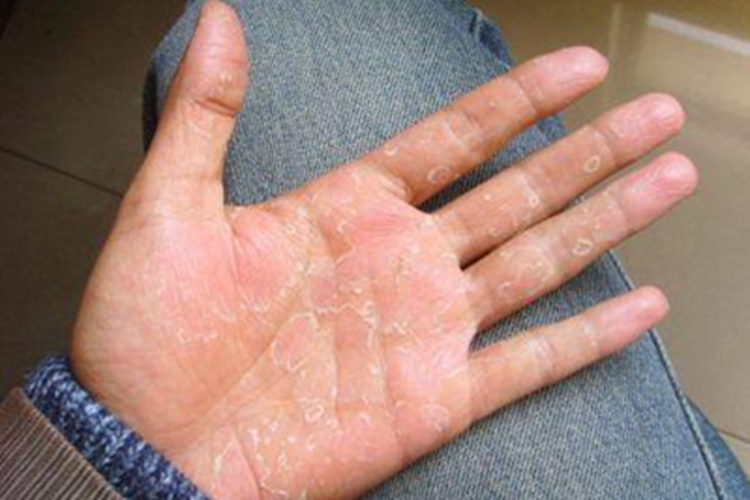 甲状腺功能减退症手掌皮肤脱皮图