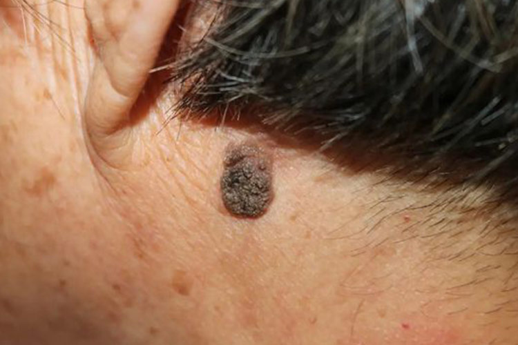 脂溢性角化症图