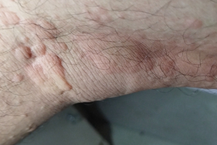 荨麻疹腘窝风团图