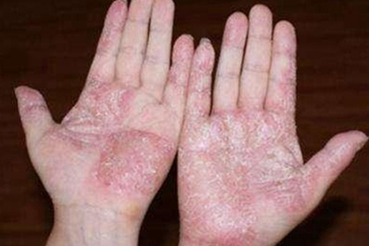手部湿疹手掌大片红斑脱屑图