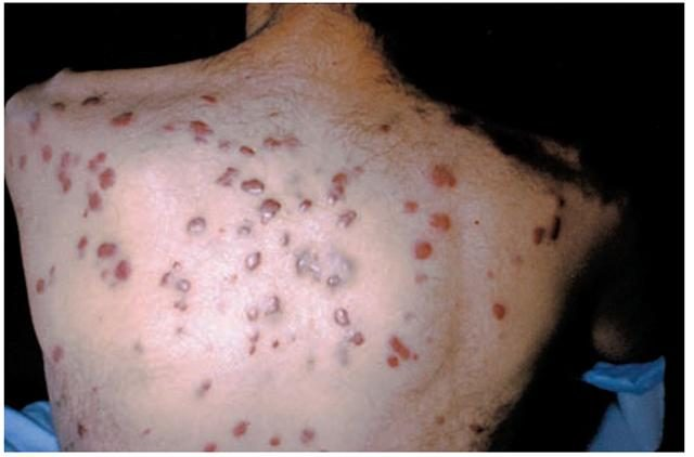 后背卡波西肉瘤图 后背卡波西肉瘤图