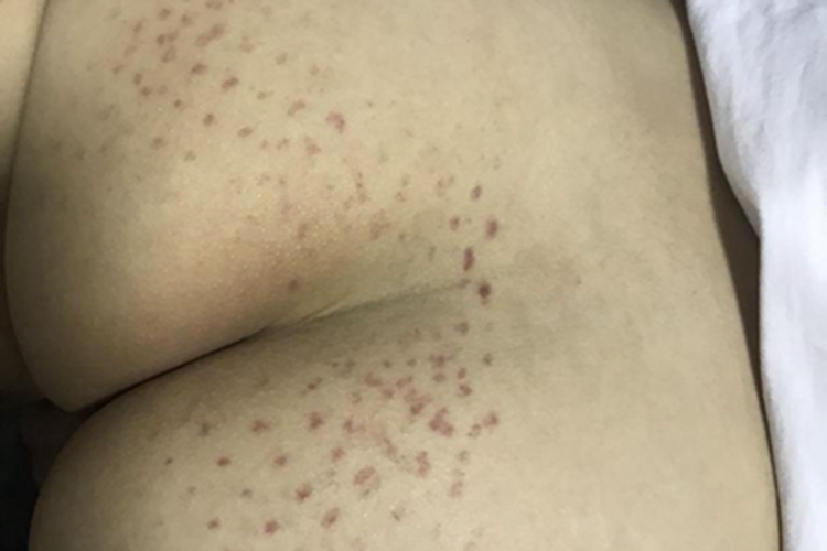 单纯性紫癜臀部紫斑图