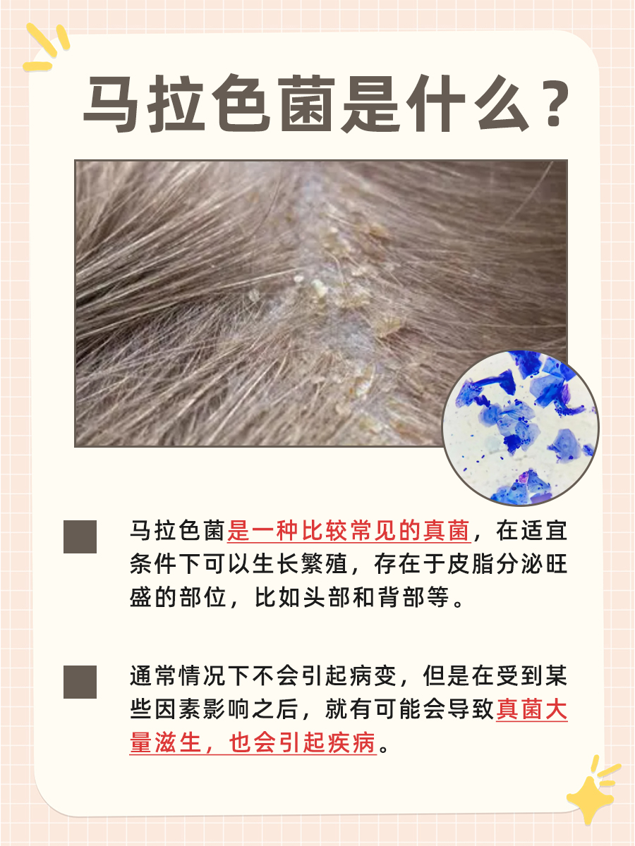 医生解析：带你了解马拉色真菌