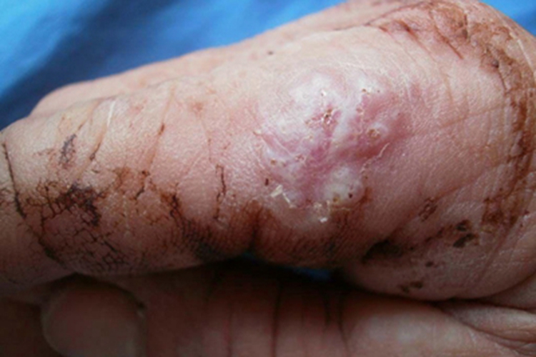 鼻孢子菌病手指疙瘩图