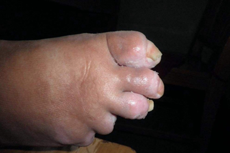 掌跖角皮症脚趾症状图