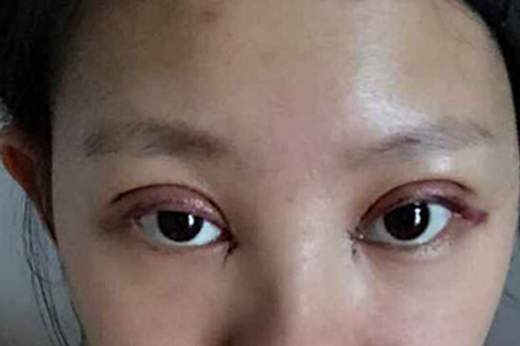 全切双眼皮眼睑外翻严重图 全切双眼皮眼睑外翻严重图