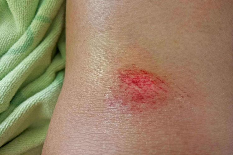 腿摔伤第一天擦伤图