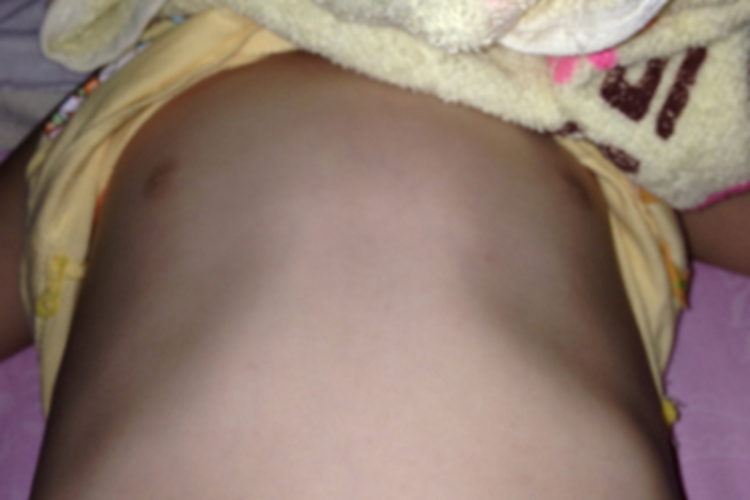 佝偻病肋骨外翻图