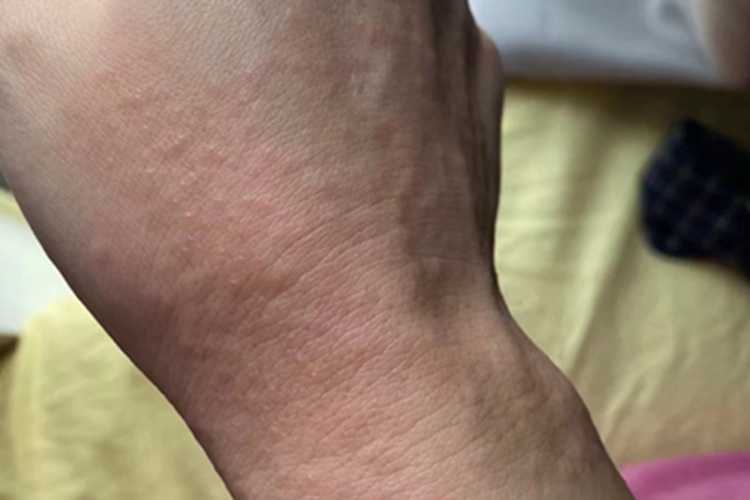 荨麻疹型药疹手背症状图