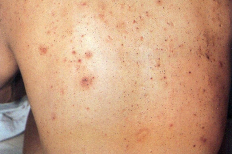 油痤疮背部黑头粉刺图