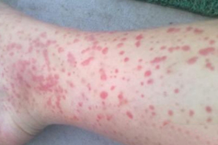 红绀病小腿症状图 红绀病小腿症状图