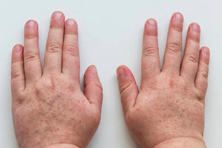 普通型猩红热丘疹图