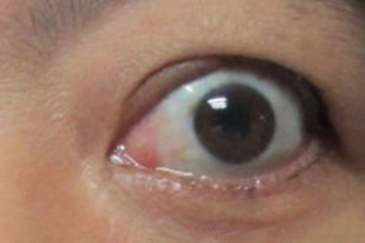 甲状腺相关眼病眼部畸形图 甲状腺相关眼病眼部畸形图