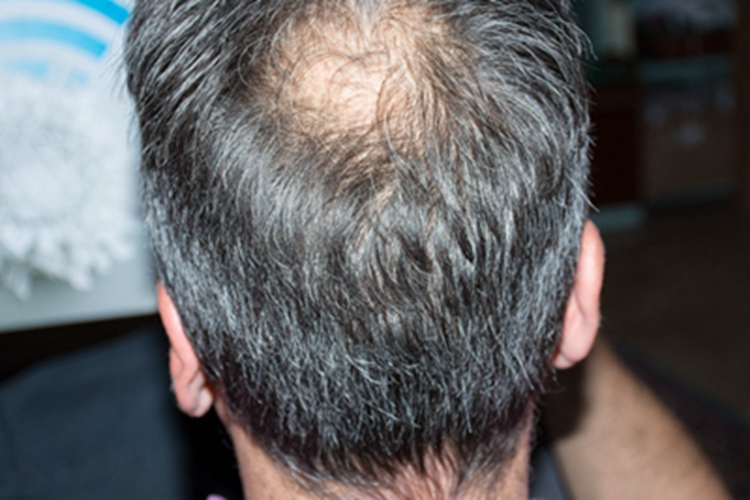 生长期脱发后脑勺脱发图 生长期脱发后脑勺脱发图