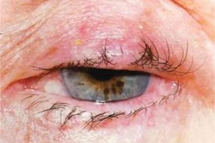 睑板腺癌眼睑肿块图