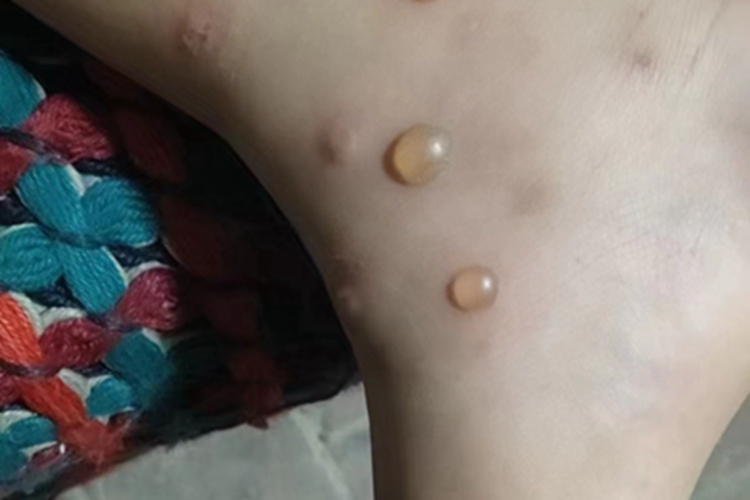 丘疹性荨麻疹大水疱图