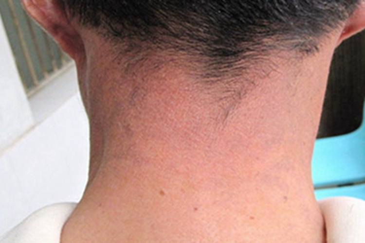 黑变病后颈皮肤红斑图