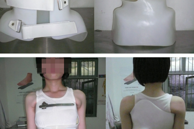 固定式胸椎支具矫形器图