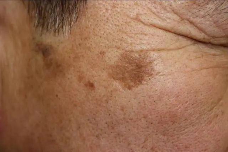 老年斑图 老年斑图