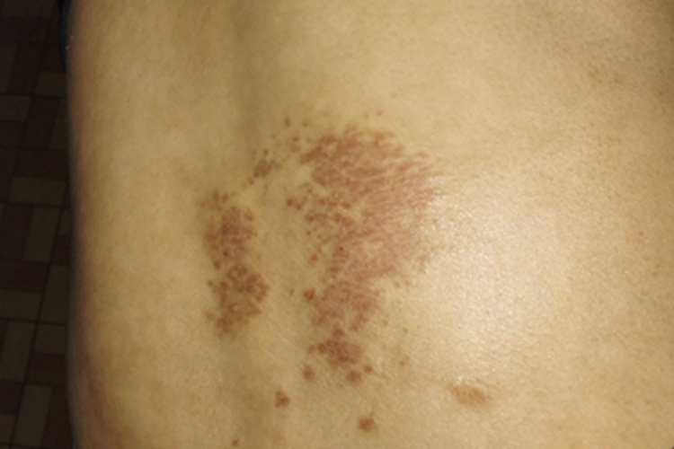 亚急性湿疹腰部暗红斑片图 亚急性湿疹腰部暗红斑片图