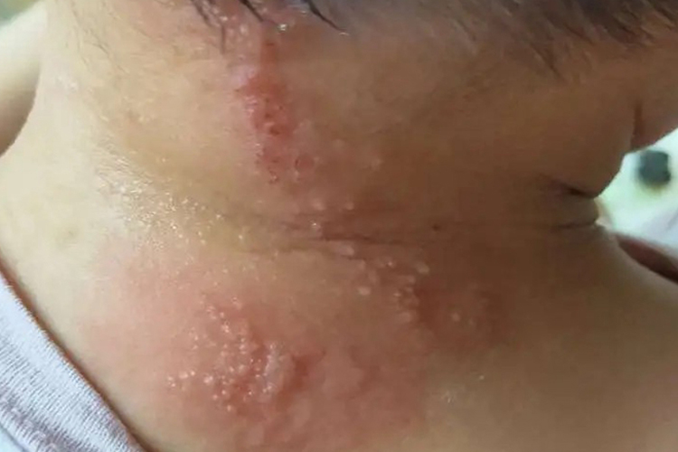 脖子水疱图 脖子水疱图