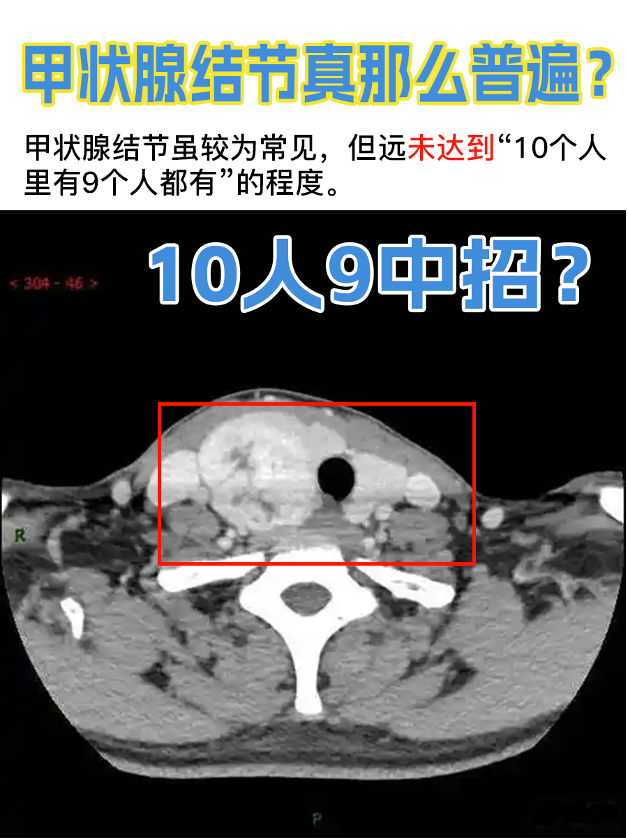 甲状腺结节真那么普遍？10人9中招？